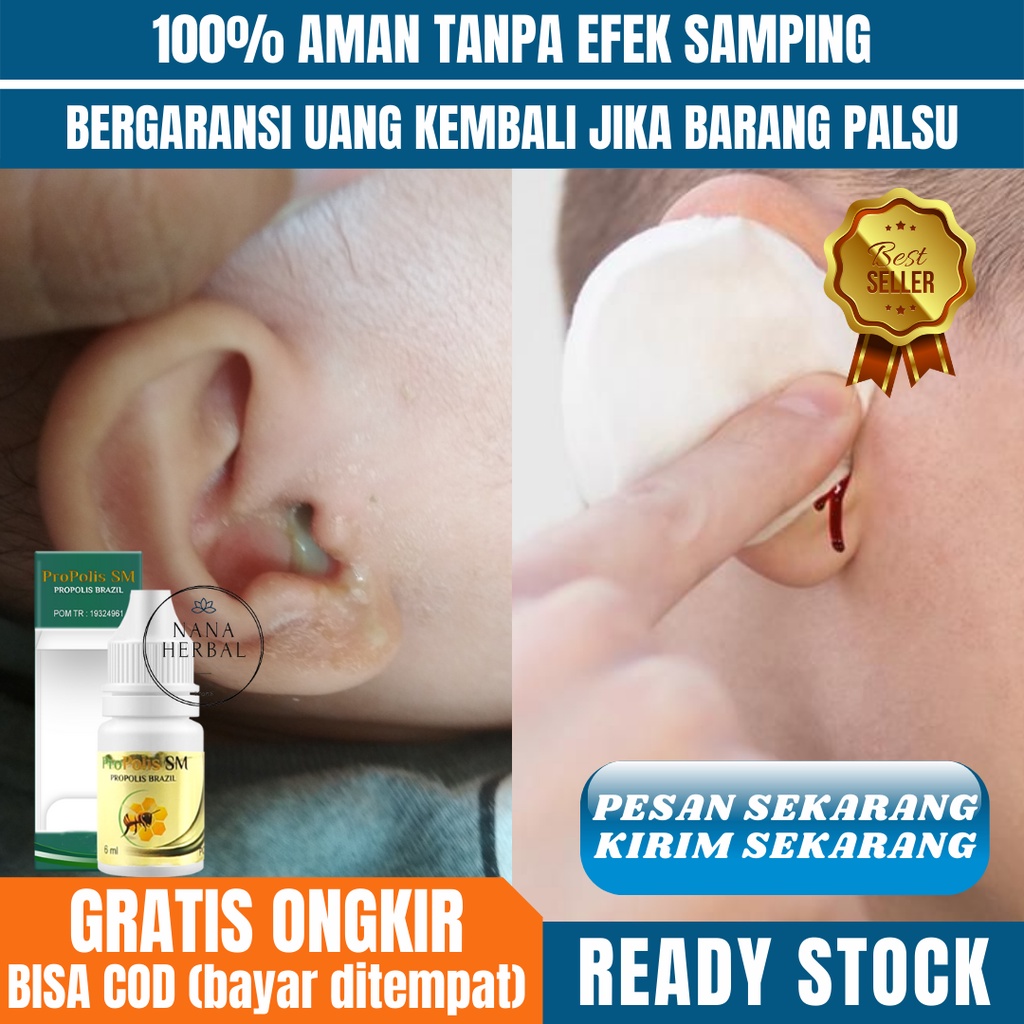 Obat Telinga Congek, Obat Telinga Curek, Obat Telinga Berair Bernanah Berdarah, Obat Nyeri Telinga a