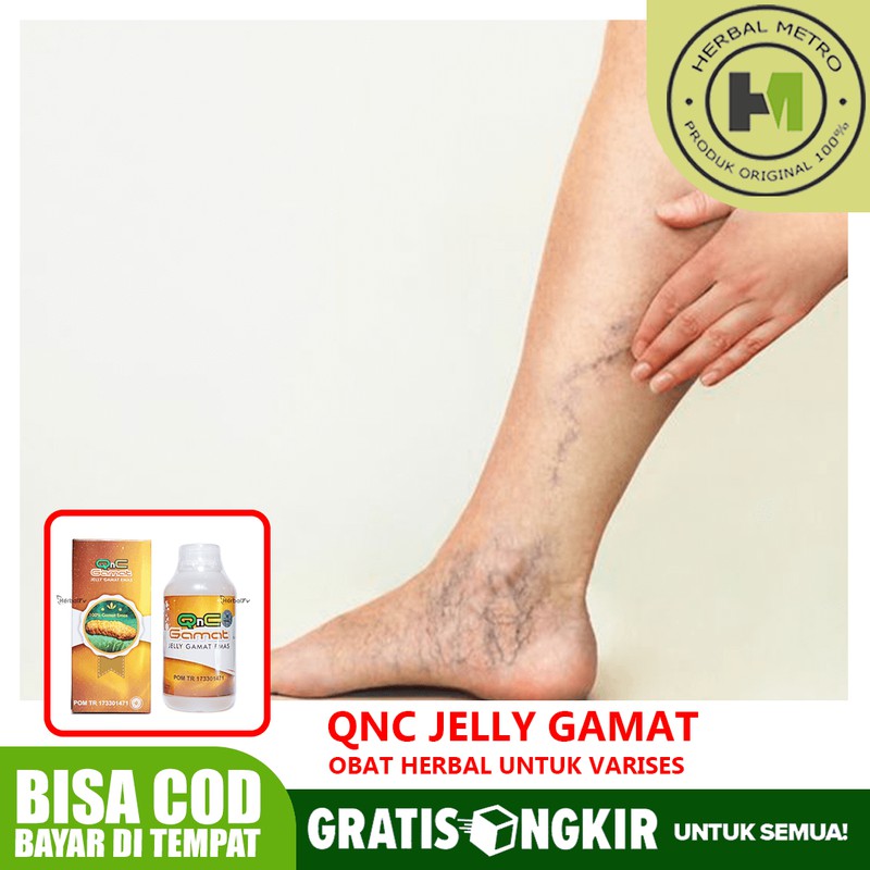 

Obat Varises Varius Di Kaki Herbal QNC JELLY GAMAT Yang Aman
