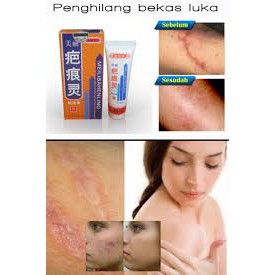 Meilibahenling Penghilang bekas luka / Cacar / Noda Kulit - Meili