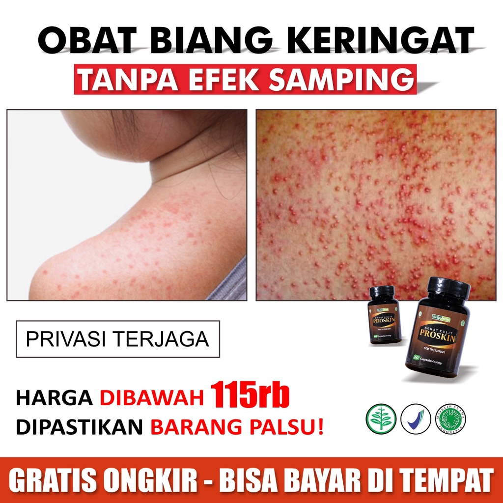 Jual Biang Keringat Ruam Kulit Bercak Bintik Merah Gatal Obat Kutu Air Cacar Api Campak Borok 2927