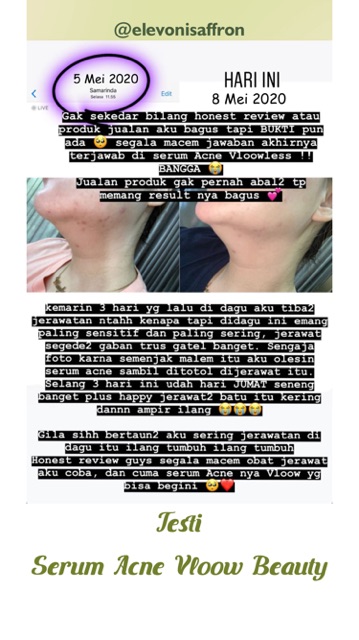 vloowless acne serum