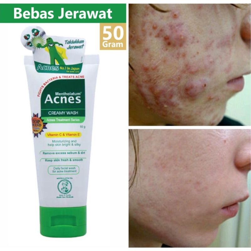 Acnes Creamy Wash/Sabun pembersih Wajah Jerawat