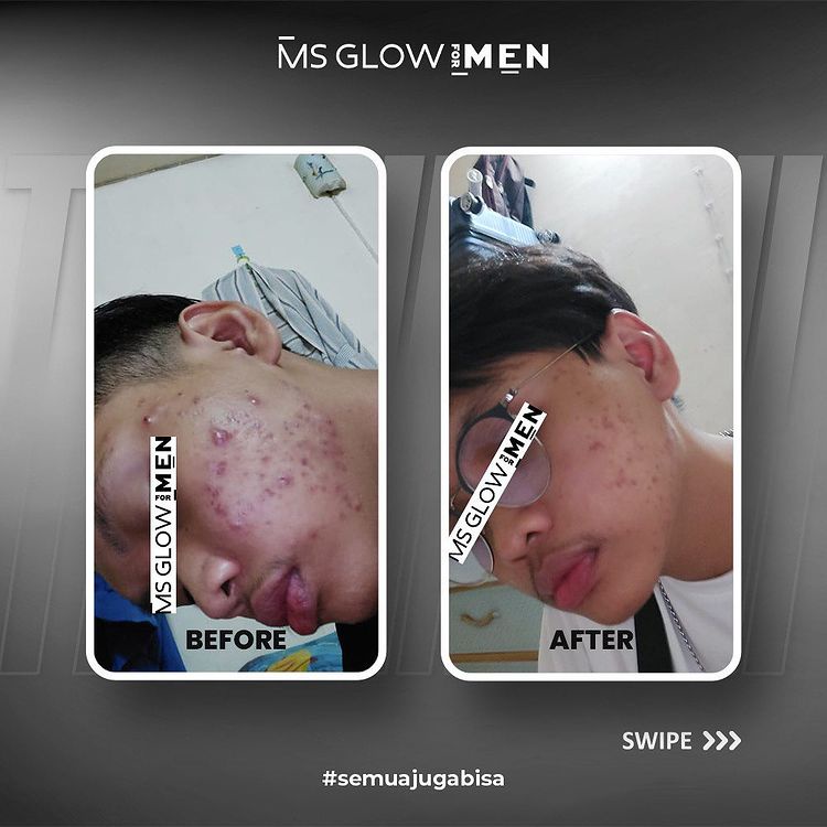 MS Glow Men Paket Basic Original Skincare Pria Mencerahkan Kulit Atasi Jerawat Komedo BPOM-5