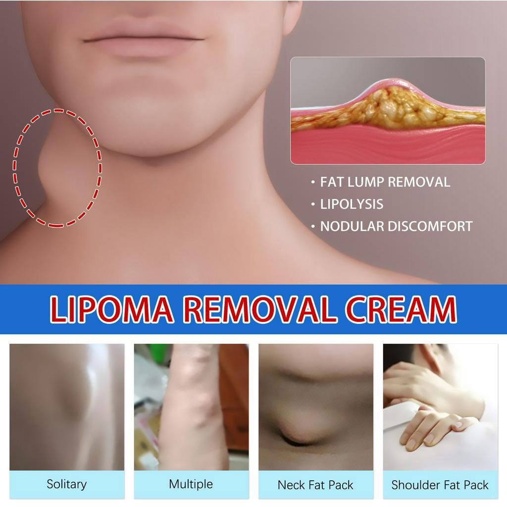 Obat Benjolan Obat Benjolan Lipoma Untuk Leher/Tangan/Ketiak/Punggung Pundak/Kaki - Lipoma Removal Cream 20gr ORI 100%