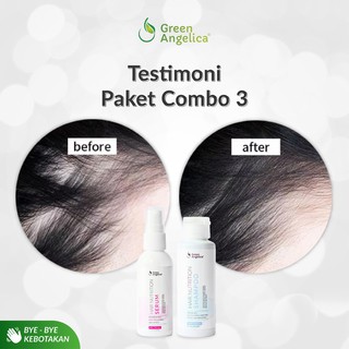 Shampo Dan Serum Green Angelica Untuk Mencegah Kebotakan 