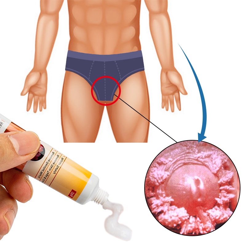 [Privasi Terjaga] KanyeHB Obat Kutil kelamin HPV Perontok Kutil Kelamin Pria / Wanita Salep Kutu Pubis Kelamin Penghilang Kutu Kelamin Genital Wart Remover -20gr