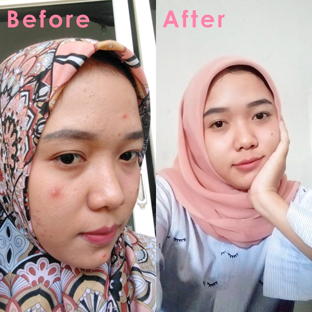 Beacuir Serum Penghilang Jerawat Komedo Perawatan Pembersih Wajah