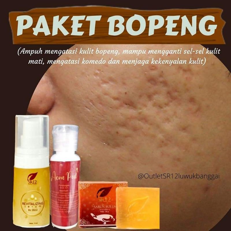 AMPUH PENGHILANG BOPENG / PENGHILANG BEKAS JERAWAT / BOPENG / SCAR