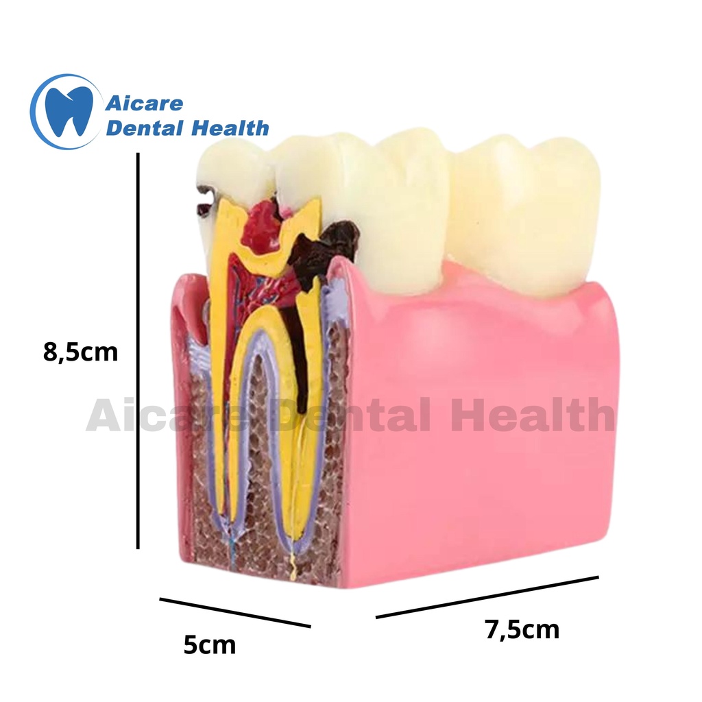 Dental Model 6X Tooth Decay 2 Side - Model Gigi Karies 6X 2 Sisi