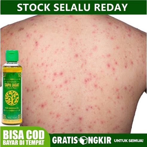 Minyak Oles Balur Gatal- Gatal di Seluruh Tubuh, Infeksi Jamur, Penghilang Gatal di Punggung & Tubuh