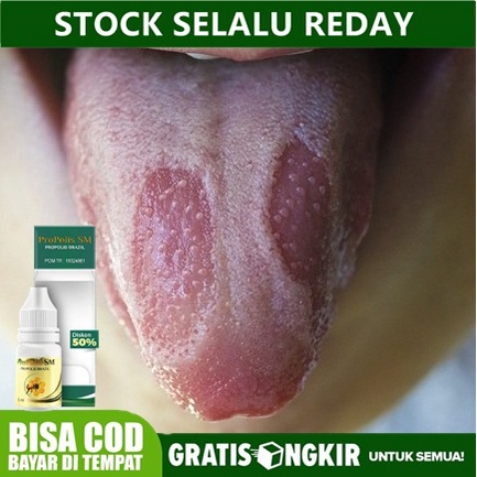 Obat Sariawan di Lidah, Lidah Lecet, Lidah Putih, Lidah Melepuh, Putih Terasa Pahit - PROPOLIS SM