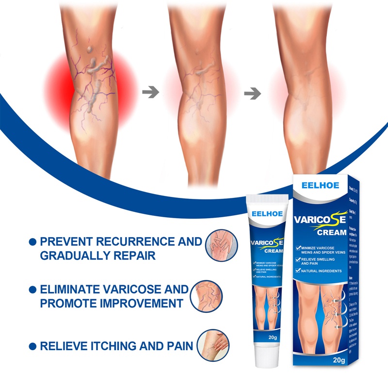 Salep Varises Cream Varicose Veins Obat Varises Kemaluan Bengkak Benjolan Buah Zakar Nyeri Testis Varicose Veins Cream 20Gr