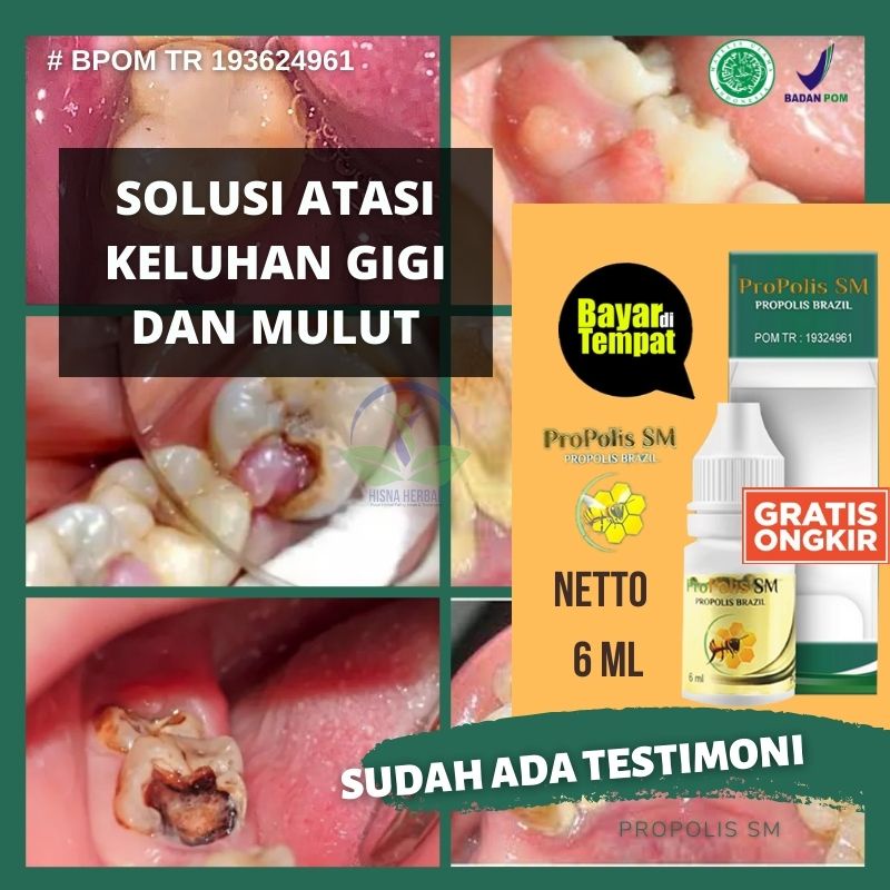 OBAT PENGHANCUR GIGI BERLUBANG, PERONTOK GIGI BOLONG PARAH SAMPAI KE AKAR GIGI, PENCOPOT SISA GIGI G