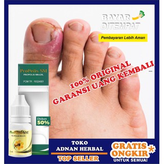 Obat Herbal Kaki Bengkak Karena Jantung Ginjal Diabetes Kolestrol Saat Hamil Gamat Qnc Shopee Indonesia
