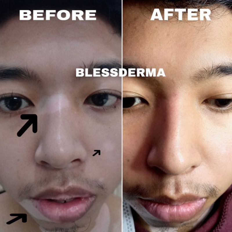 Cream Vitiligo 0,1 Superprotein