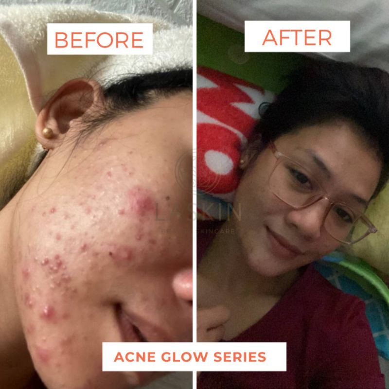 LASKIN PAKET ACNE GLOW SERIES ( FREE POUCH )-6