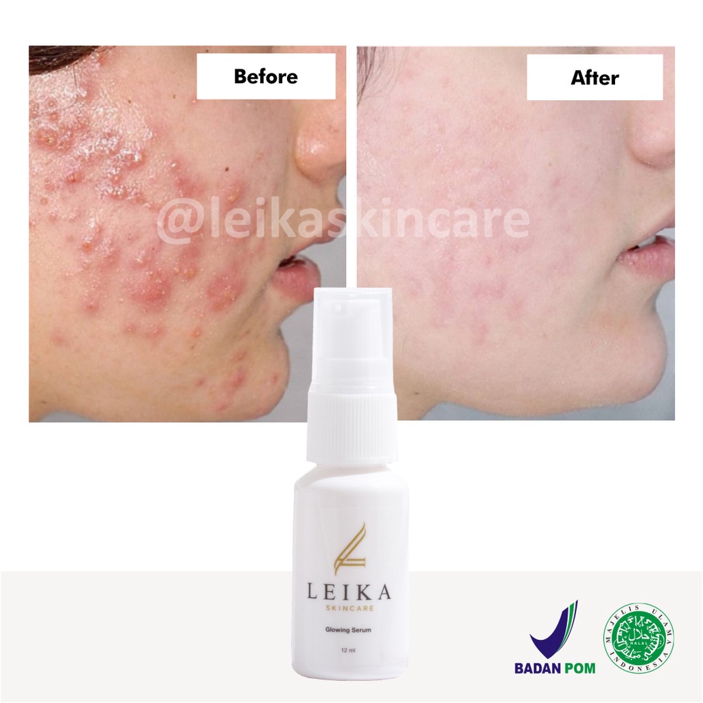 Serum Penghilang Jerawat Batu Radang Ampuh Serum Jerawat Meradang Penghilang Bekas Jerawat Meradang Obat Jerawat Batu Meradang Asli HALAL MUI Glowing Serum Leika Skincare Resmi BPOM
