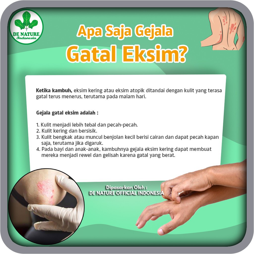 Obat Herbal Exim/Eksim Basah/ Eksim Kering Kadas Kudis Asli Ampuh Dan Tanpa Efek Samping DeNature-2