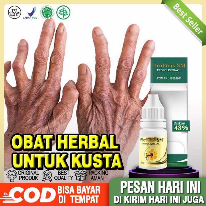 Jual Obat Herbal Kusta Kering & Basah, Lepra, Penyakit Kulit - Propolis ...