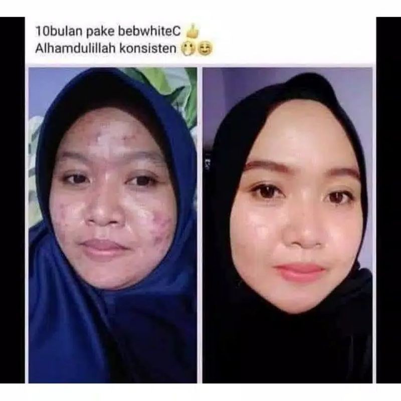 BEB WHITE C SKINCARE ORIGINAL 100% Glowing Series - Acne Series