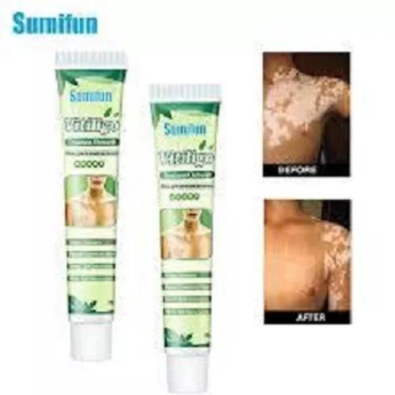 SUMIFUN VITILIGO OBAT PENGHILANG BERCAK PUTIH HERBAL AMPUH MENGHILANGKAN PIGMENT PUTIH  MERATAKAN WARNA KULIT-20gr