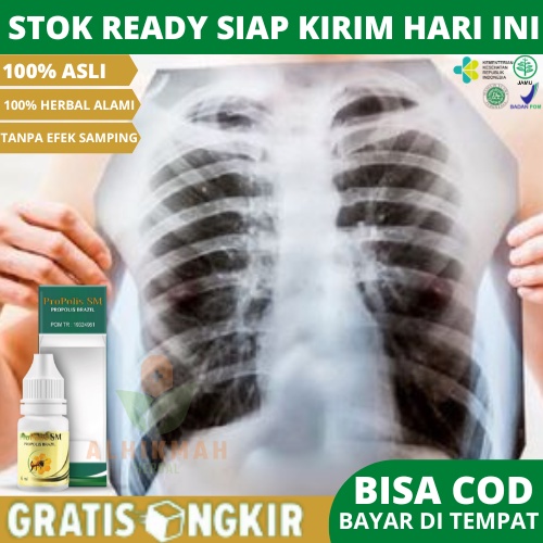 Obat Gangguan Paru Paru, Infeksi Paru Paru, Radang Paru Paru, Obat Paru Paru Basah, Obat Sesak Nafas