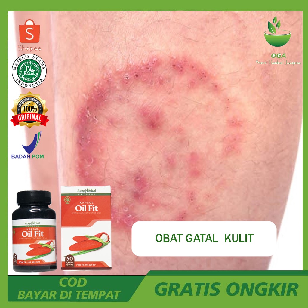 Obat Gatal Gatal Pada Kulit - Obat Gatal Gatal Pada Kulit Bruntusan - Obat Gatel2 Seluruh Badan Buat