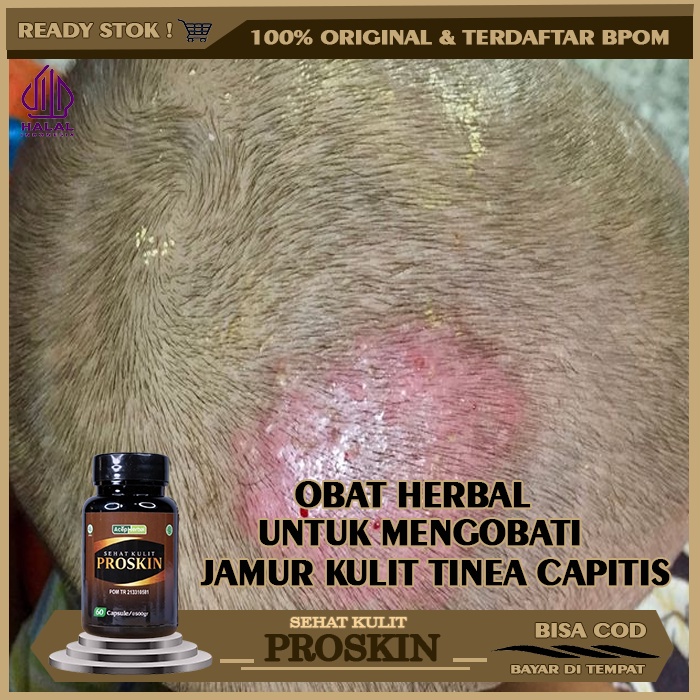 Obat Infeksi Jamur Kulit Tinea Capitis, Obat Tradisional Tinea Capitis, Obat Tinea Capitis (Kurap Ku