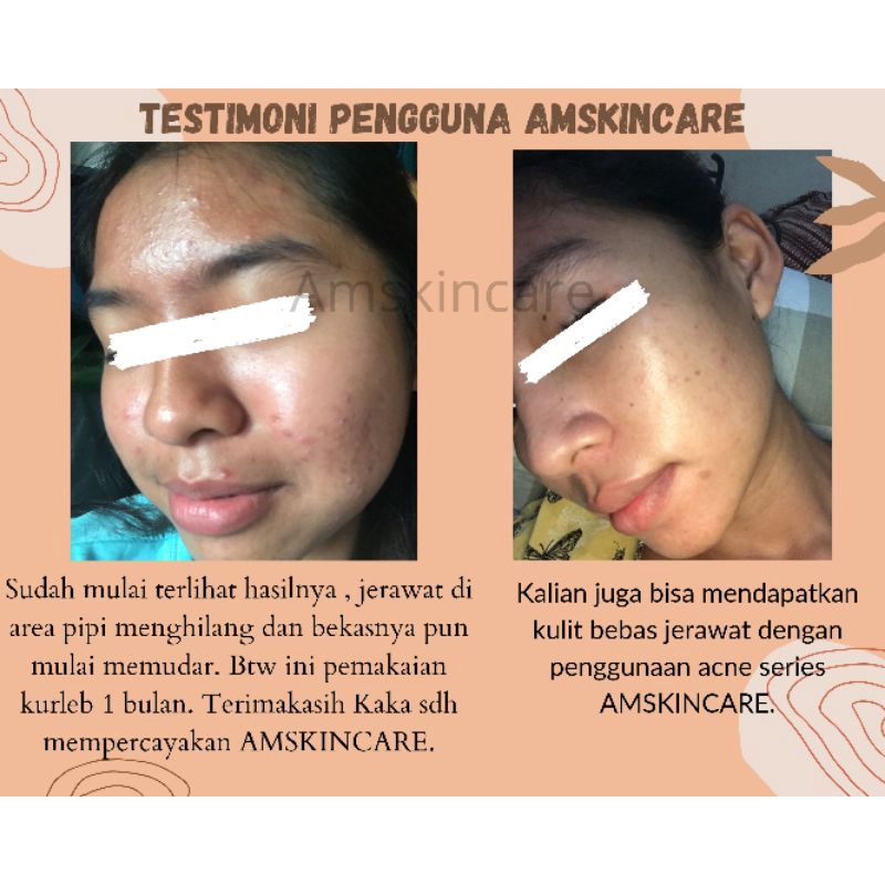 CREAM MALAM ACNE/JERAWAT BY AMSKINCARE | AMPUH USIR JERAWAT BANDEL BERUNTUSAN BOPENG