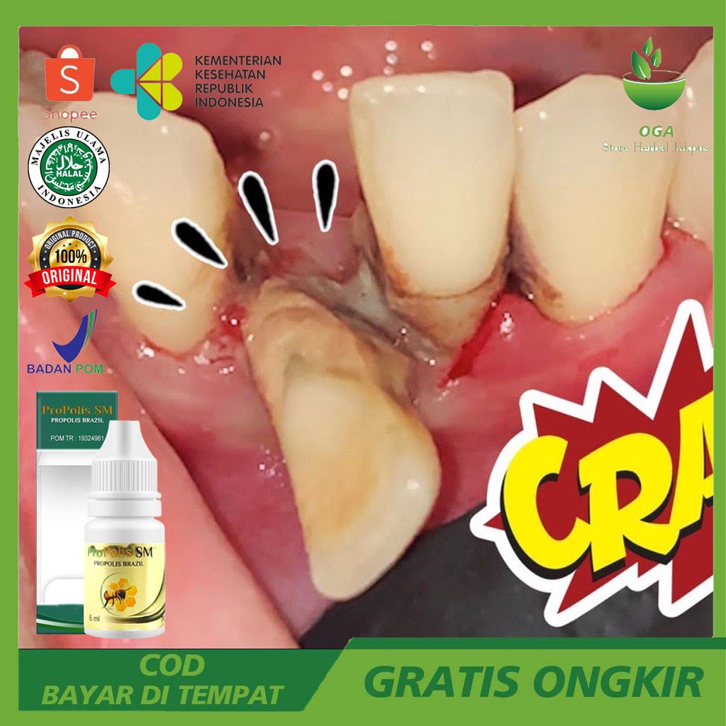 Obat Gigi, Penguat Gigi, Gigi Goyang, Ompong, Gigi Bolong, Gigi Keropos, Gigi Berlubang, Gigi Berlob