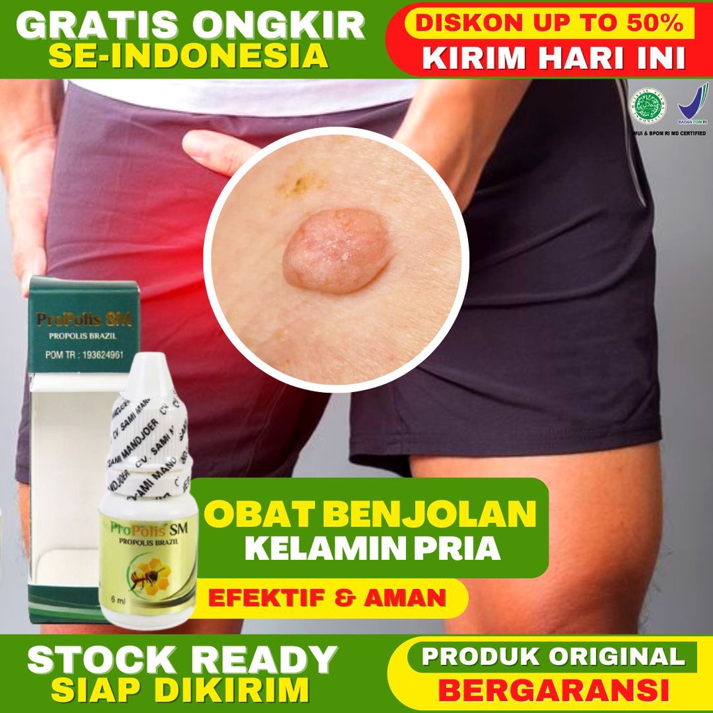 Obat Benjolan di Alat Kelamin Pria Benjolan Gatal Obat Gatal Area Kelamin Pria Kutil Kelamin Sifilis