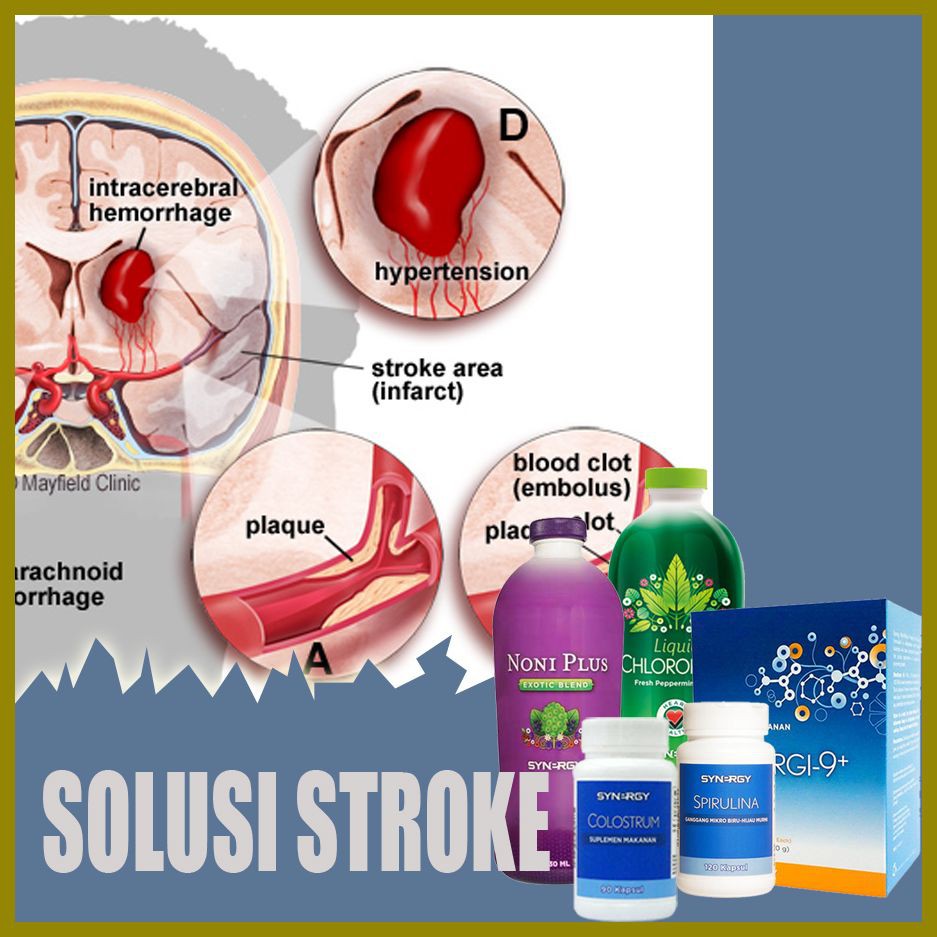 Terapi Penyakit Stroke Ringan Stroke Iskemik Maxipack Herbal