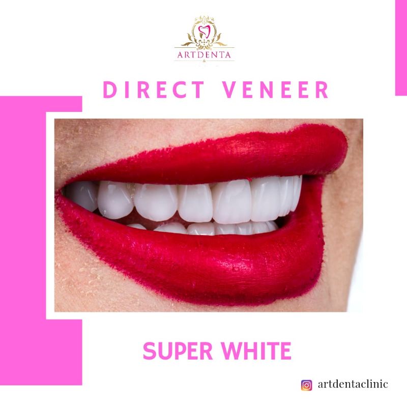 DIRECT VENEER- SUPER WHITE