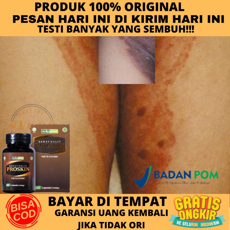 Obat Selangkangan hitam gatal, Obat Kurap Selangkangan, Salep gatal Selangkangan, Obat Gatel Selangk