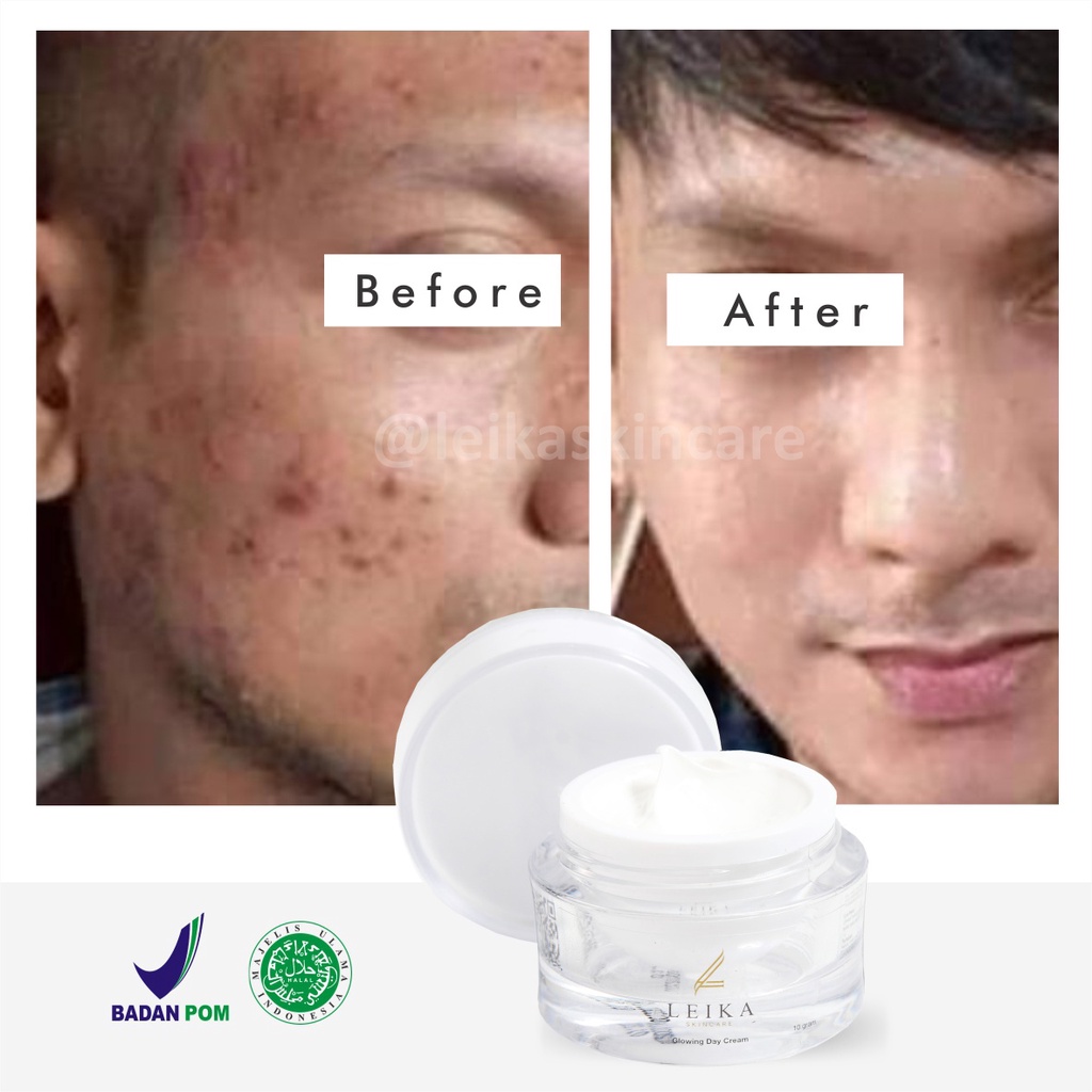 Krim Siang Penghilang Bekas Jerawat Ampuh BPOM Obat Penghilang Bekas Jerawat Pria Membandel Aman BPOM Penghilang Bekas Jerawat Penghilang Bopeng Bekas Jerawat Cream Penghilang Bekas Jerawat Day Cream Leika Skincare Penghilang Bekas Jerawat Pria Pembersi