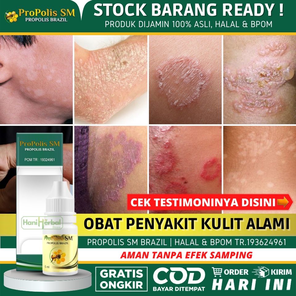 Obat Untuk Panu / Hapur 100% Alami, Obat Panu di Wajah, Obat Panu di Leher & Punggung, Penghilang Pa