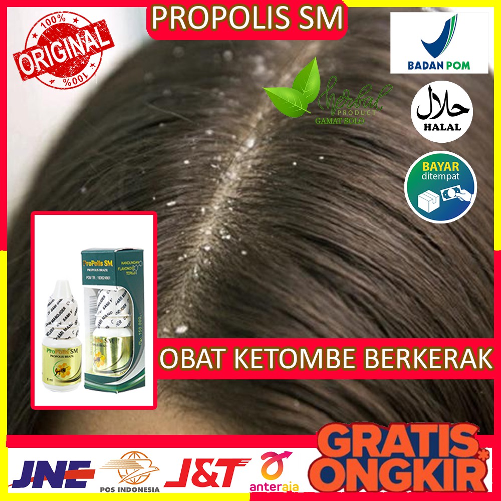 Obat Ketombe Berkerak, Ketombe Basah, Ketombe Kering, Ketombe Parah | Propolis Sm di Solo | COD