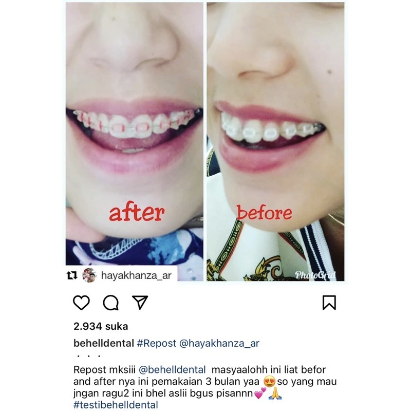 [ORIGINAL] BRACKET BEHEL PERMANEN CERAMIC CLASSONE USA // KERAMIK TRANSPARAN TRANSFARAN CLEAR DENTAL