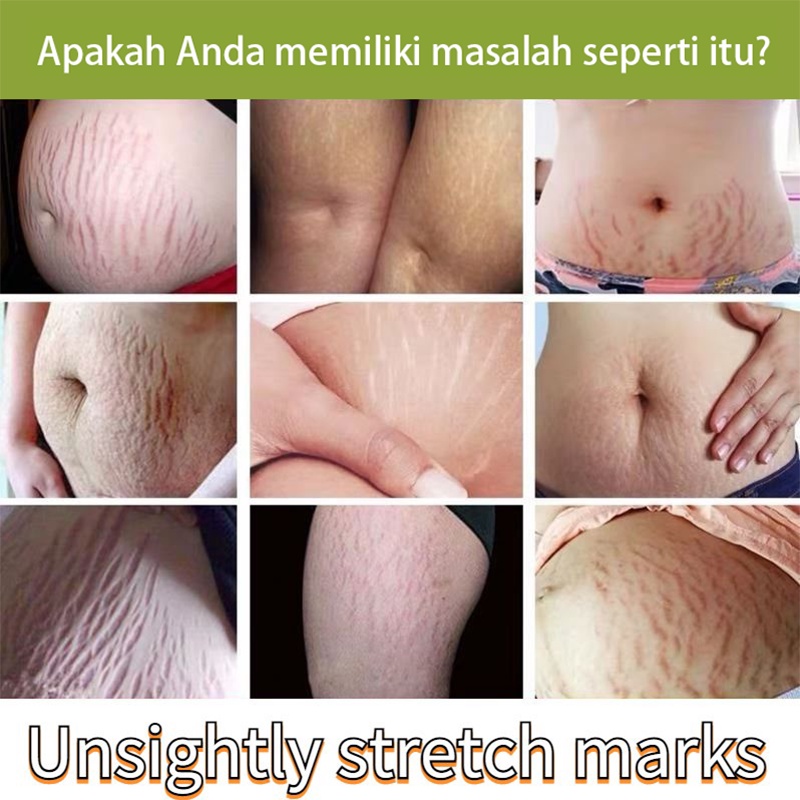 Stretch Mark Cream Mama Choice Stretch Mark 30ml  Stretch Mark Dan Obesity Mark Krim Mengencangkan Perut Stretch Mark Removal Cream Krim Perawatan Postpartum