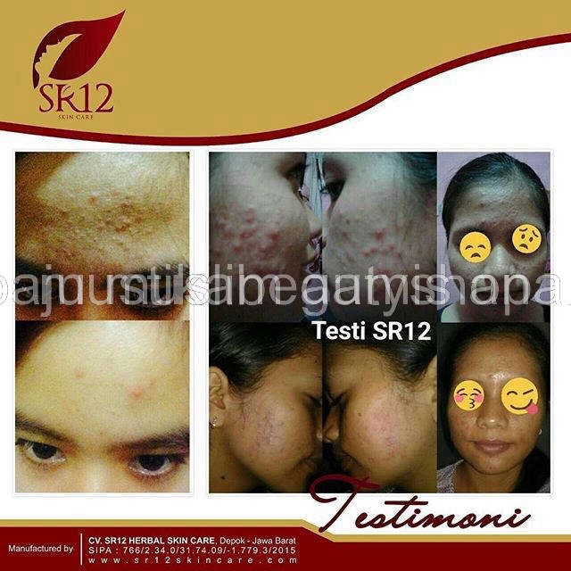 SR 12 KRIM JERAWAT ACNE  TOTOL - ACNE SERUM -ACNE MOISH- Toner acne  SR12 BPOM AMAN / MENGEMPESKAN JERAWAT / CREAM TUMPAS JERAWAT / PERAWATAN JERAWAT