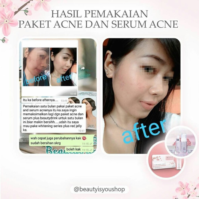 c01c1zz Paket Acne Ms Glow- Acne Series Msglow - Pkt Lengkap Zc2Z01X