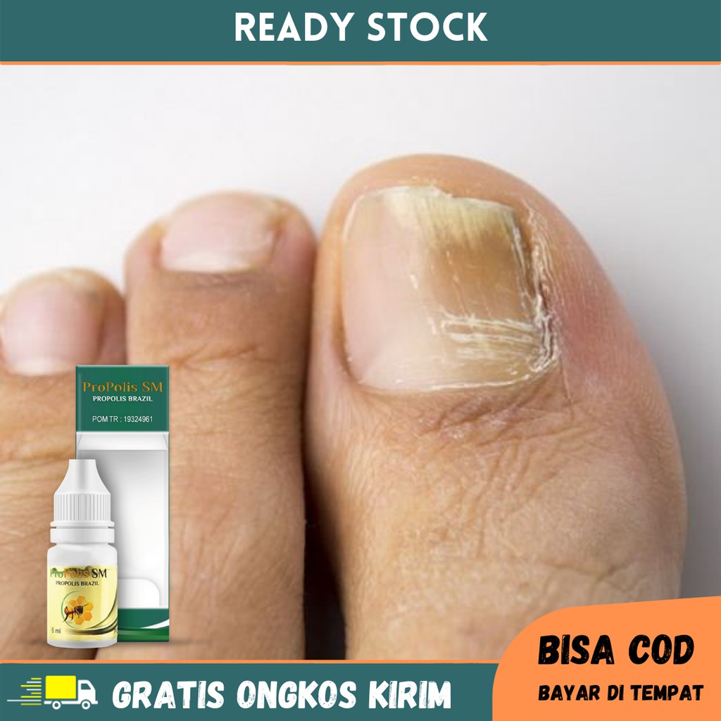 Obat Kuku Rusak, Infeksi Jamur Kuku, Kuku Bernanah, Obat Tetes Kuku Kaki Rusak