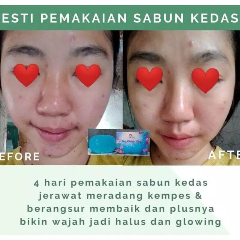 Promo Sabun Kedas Beauty 100% Original (COD dan Free Ongkir&amp;Free Gift) KEDAS SOAP