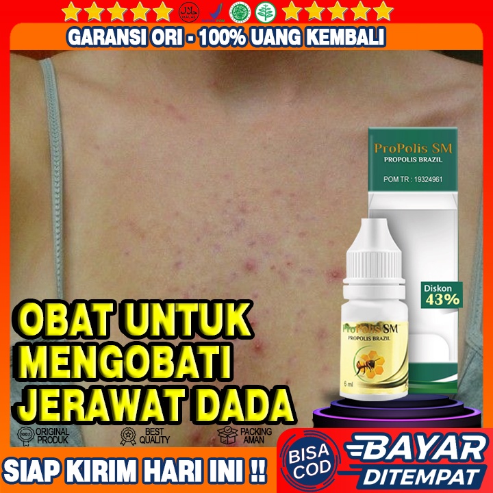 Obat Jerawat Dada, Obat Penghilang Jerawat Dada, Obat Oles Penghilang Bekas Di Jerawat Dada Propolis