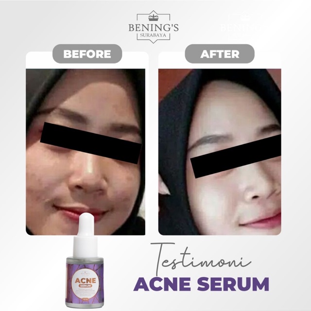 BENING'S SERUM ACNE | MENGATASI JERAWAT, BRUNTUSAN &amp; MENCERAHKAN | FREE GIFT SIAP KIRIM SELURUH INDONESIA