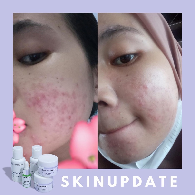 (ECER ACNE) OshinBeauty - Acne Series Oshin Beauty Skincare [Free Gift]-2