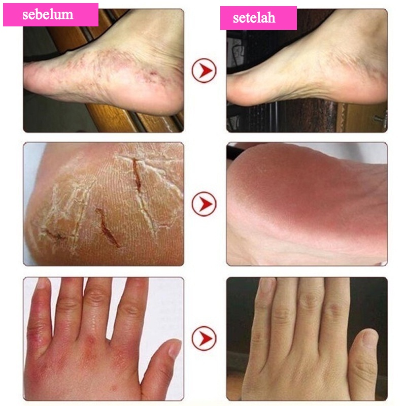 krim kaki 100g obat kaki pecah dan kering krim kaki Exfoliating Kapalan Smoothing Krim Kaki Memperbaiki tumit pecah-pecah dan kering