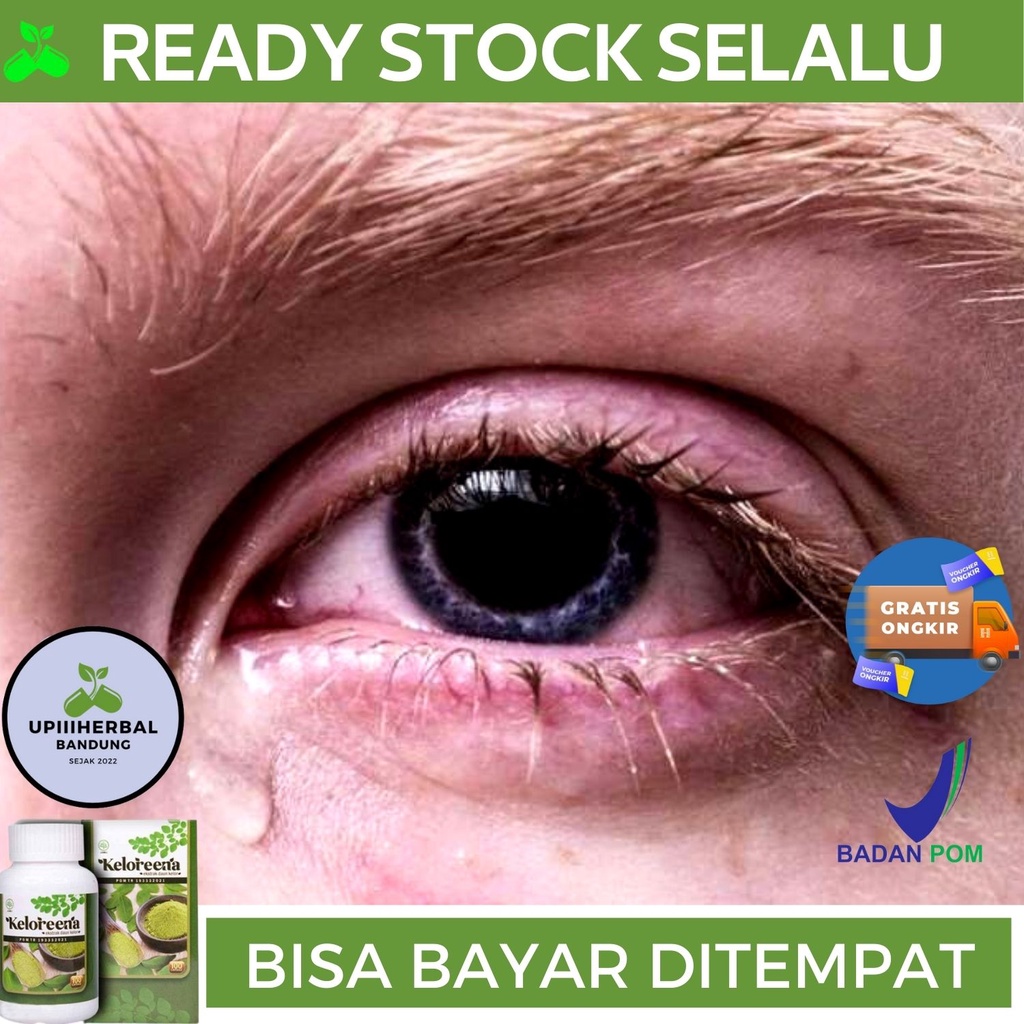 Obat Gangguan Saraf Mata, Obat Untuk Gangguan Saraf Mata, Obat Peradangan Saraf Mata, Obat Saraf Mat