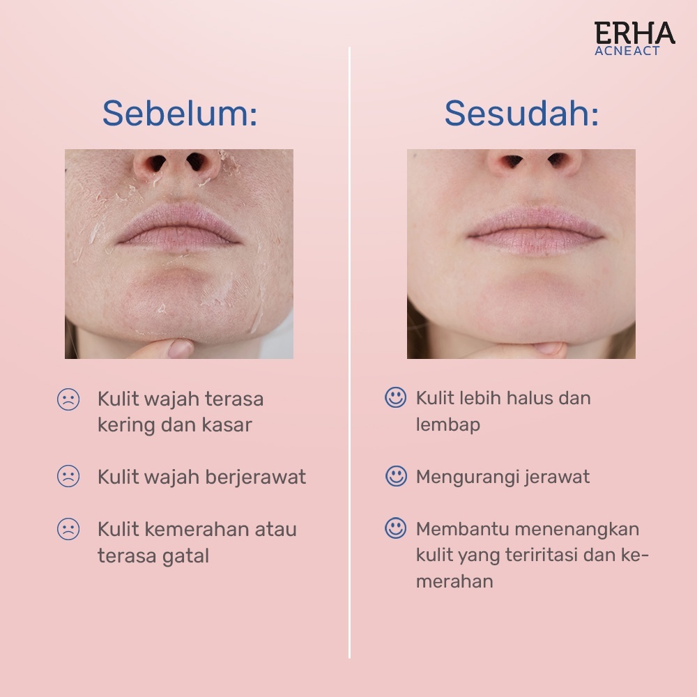 ERHA Pelembab Wajah Jerawat - Gentle Acne Moisturizer / Terbukti Klinis BPOM