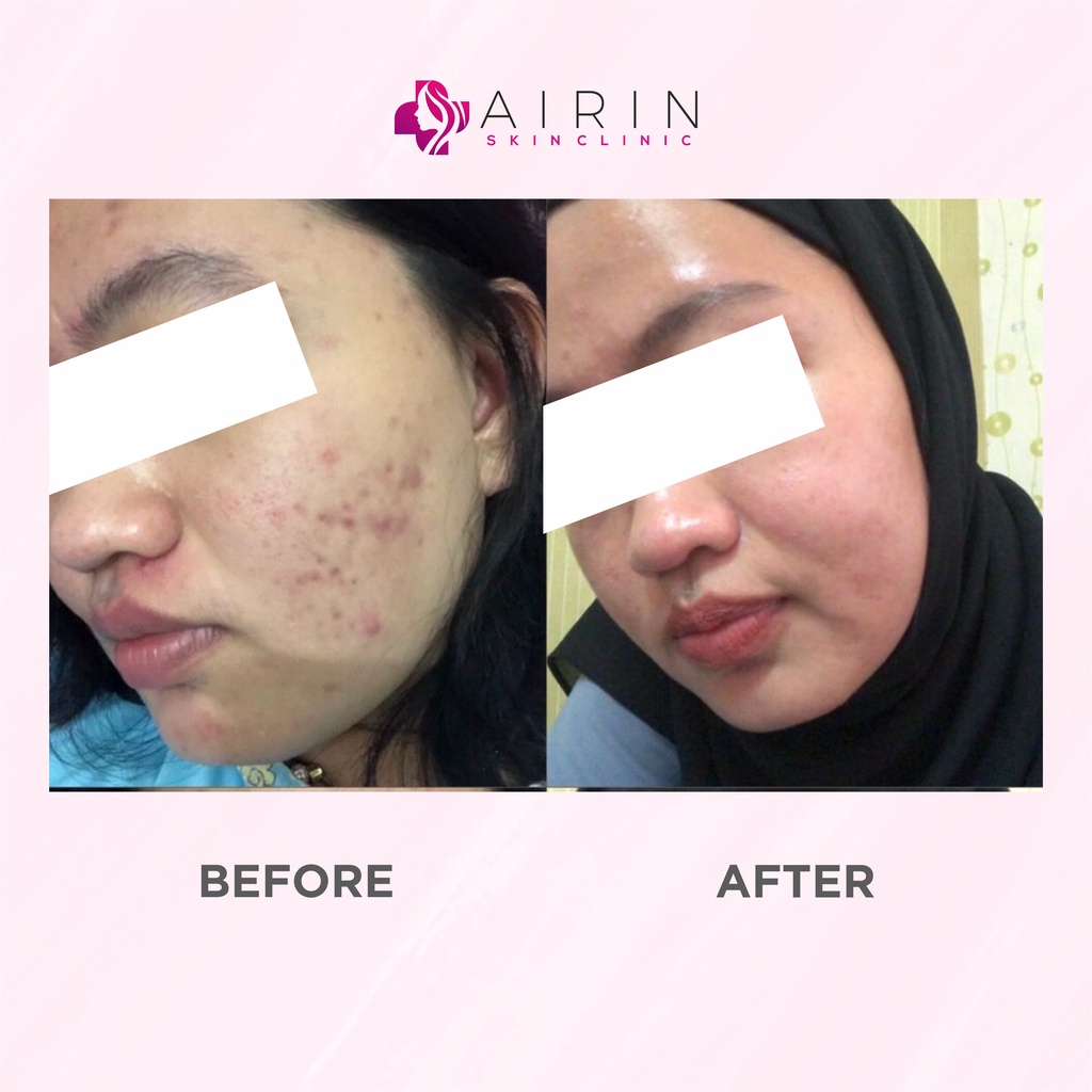 Airnderm Aesthetic Paket Acne Action FREE POUCH (by AIRIN BEAUTY)-7